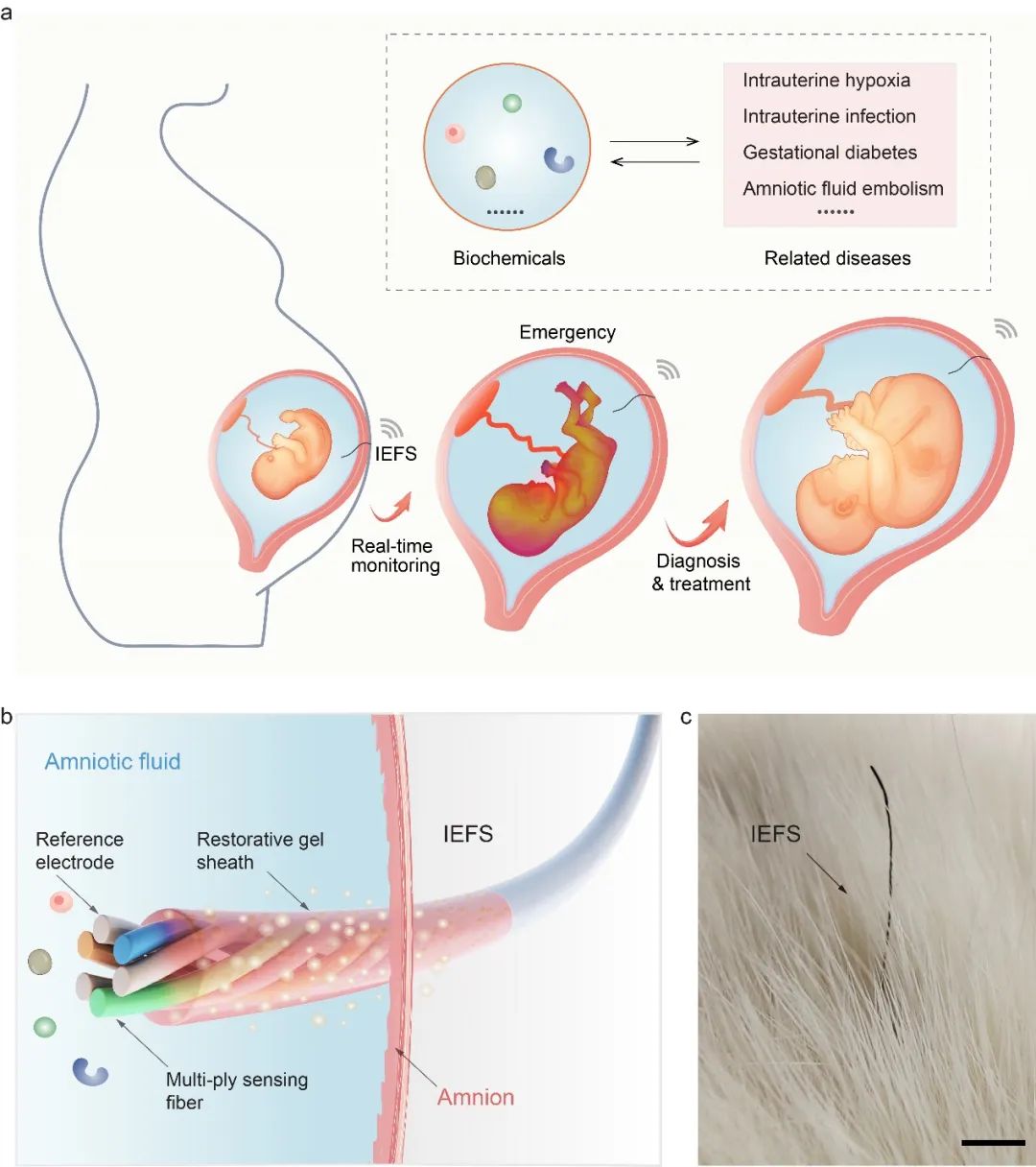 Fiber Sensor for Real-Time Amniotic Fluid Monitoring